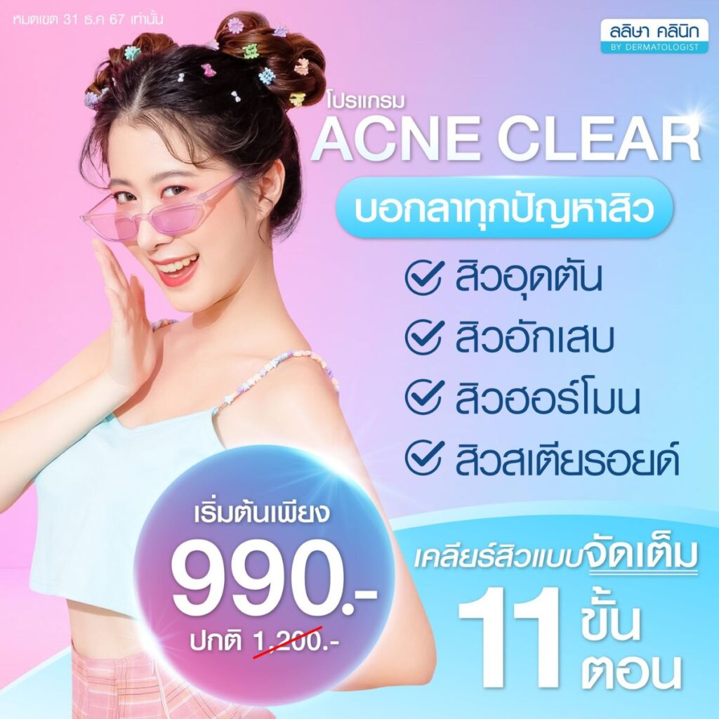 โปร Acne Clear เคลียผิวหน้าให้ไร้สิว