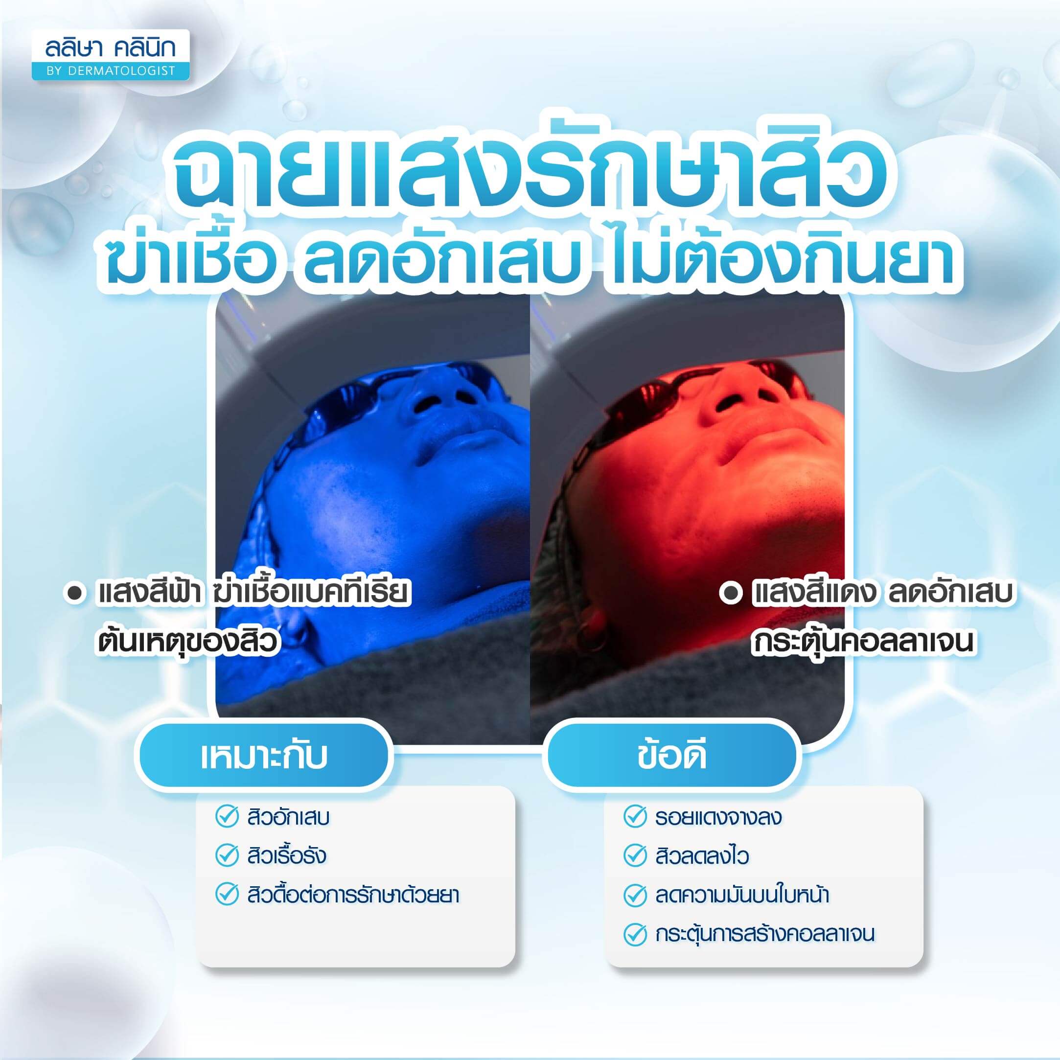 ฉายแสงรักษาสิว