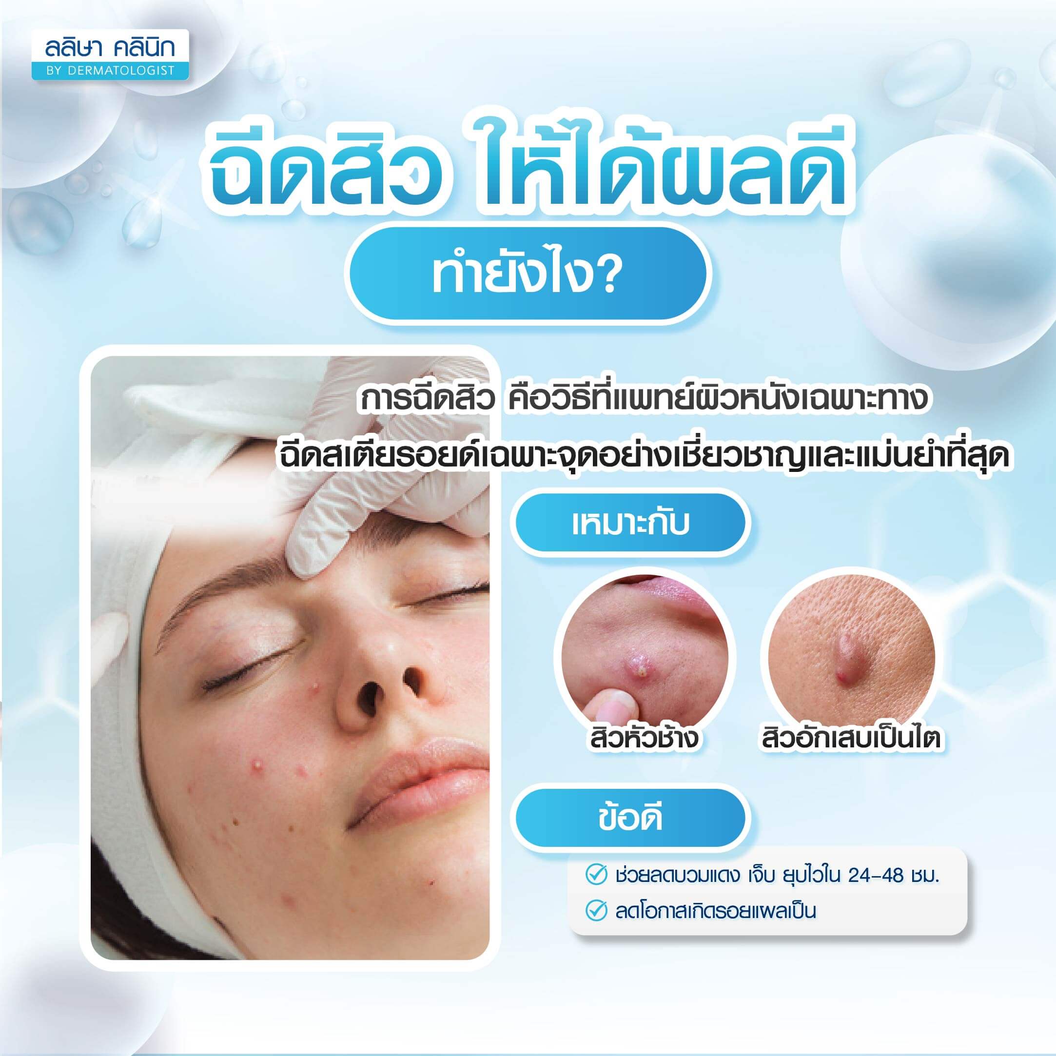 ฉีดสิว