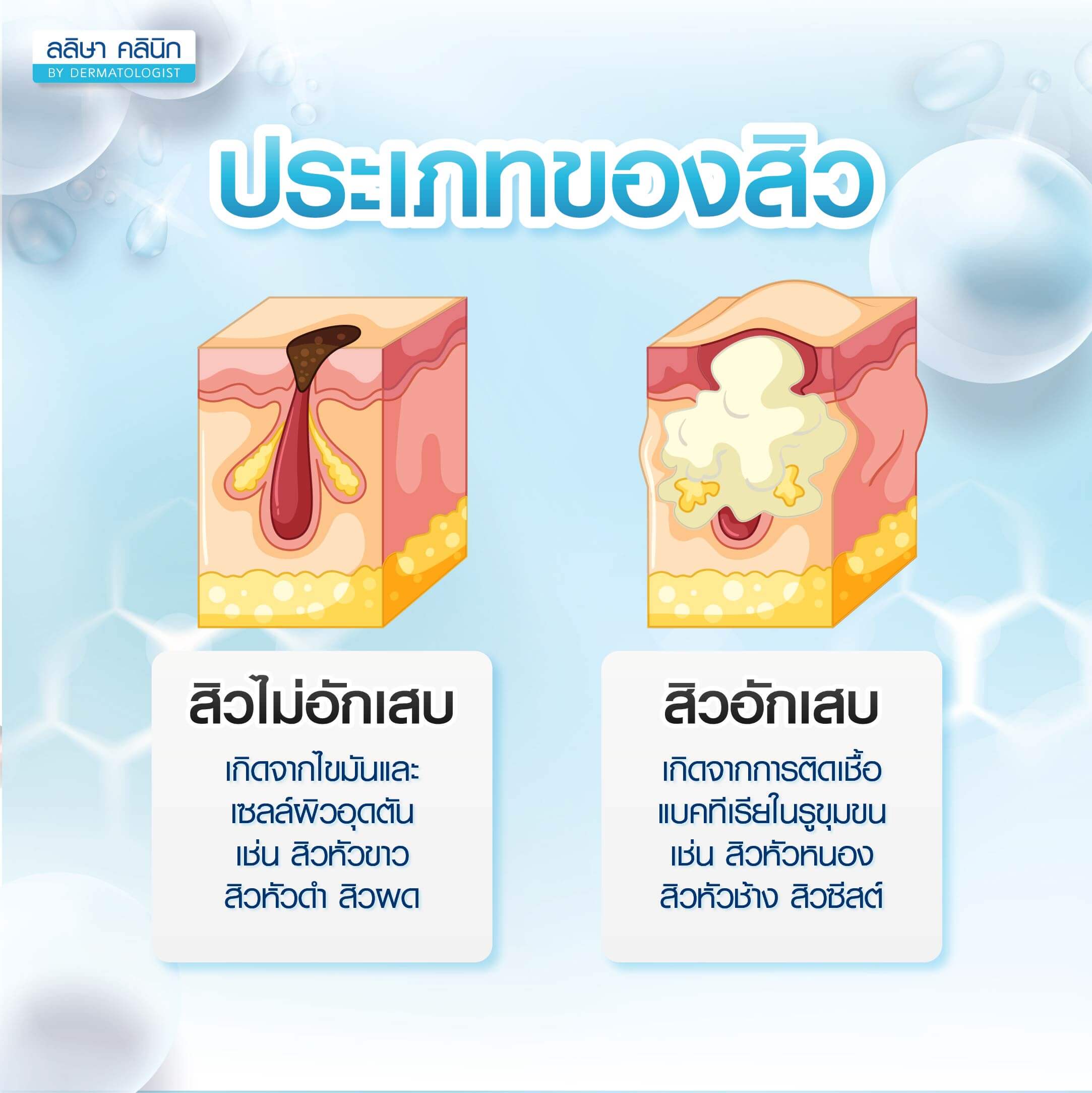 ประเภทของสิว
