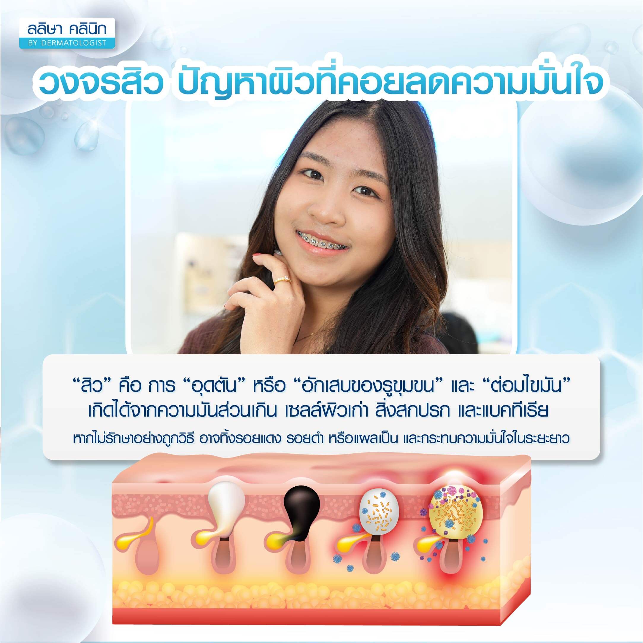 วงจรสิว