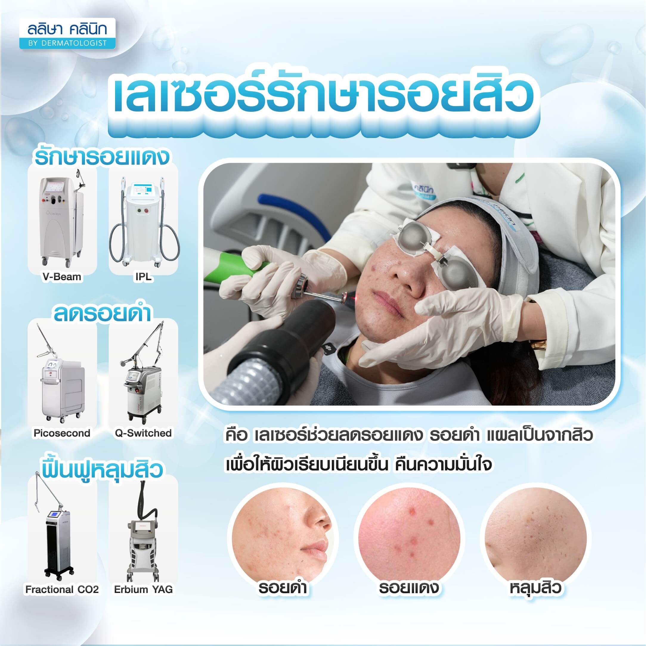 เลเซอร์รักษารอยสิว