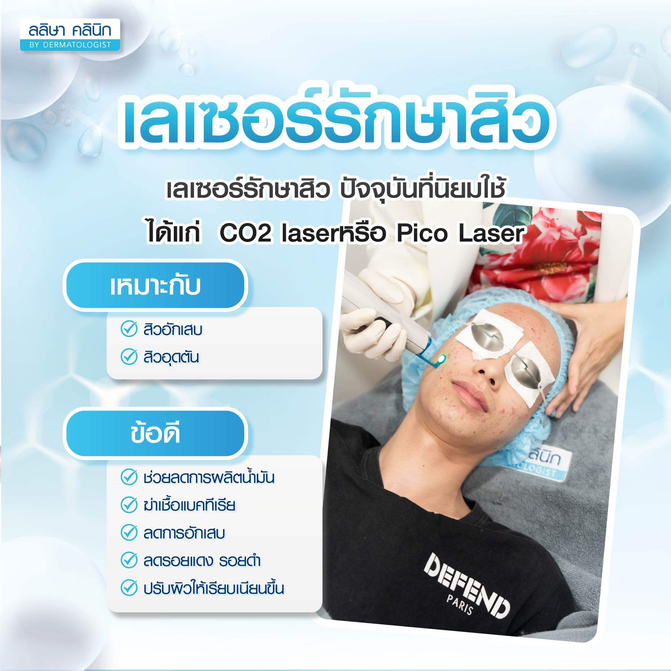 เลเซอร์รักษาสิว