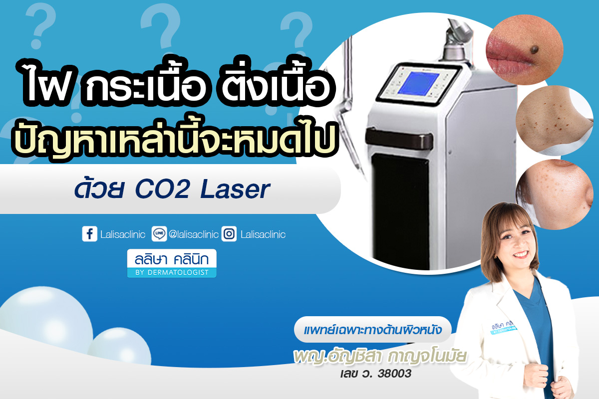 co2 laser รักษาไฝ กระเนื้อ ติ่งเนื้อ