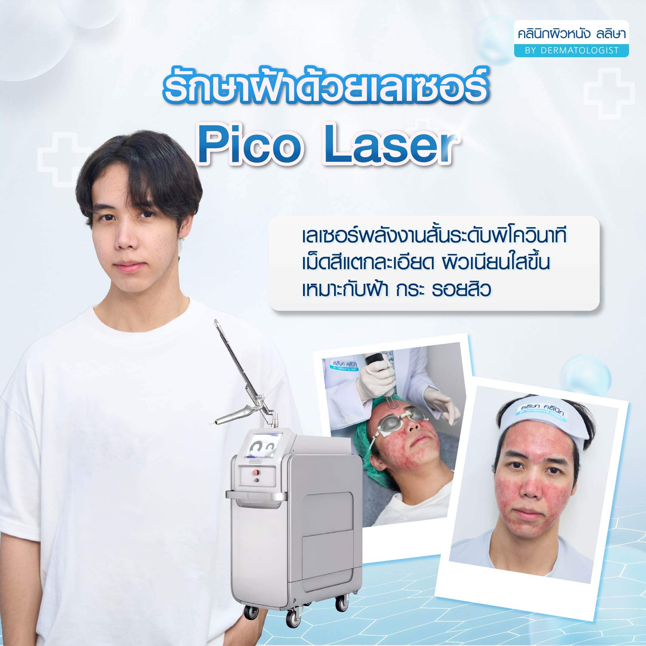 ฝ้าจางลง รักษาด้วย pico laser