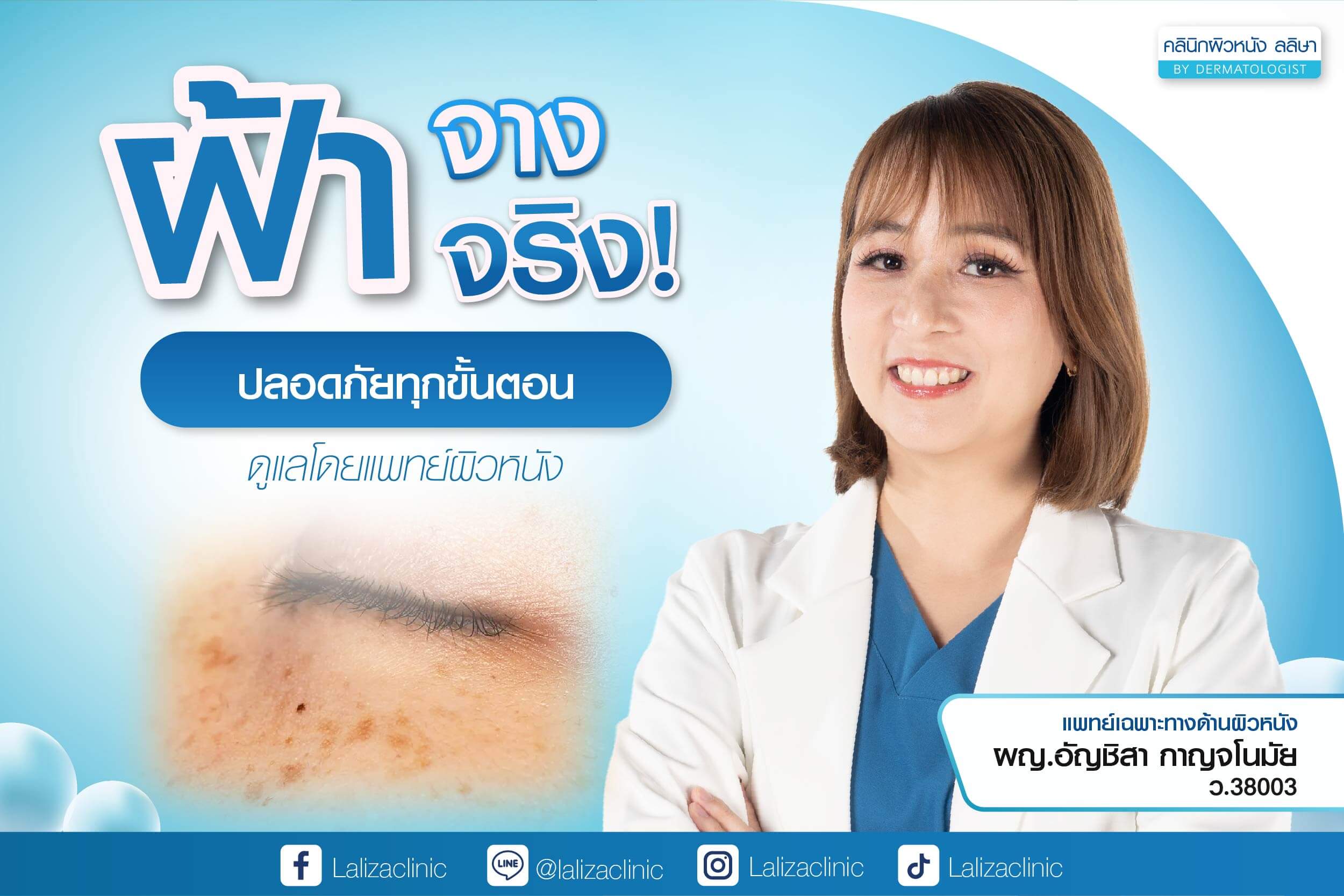 รักษาฝ้า ที่คลินิก ฝ้าจางลงอย่างเห็นได้ชัด