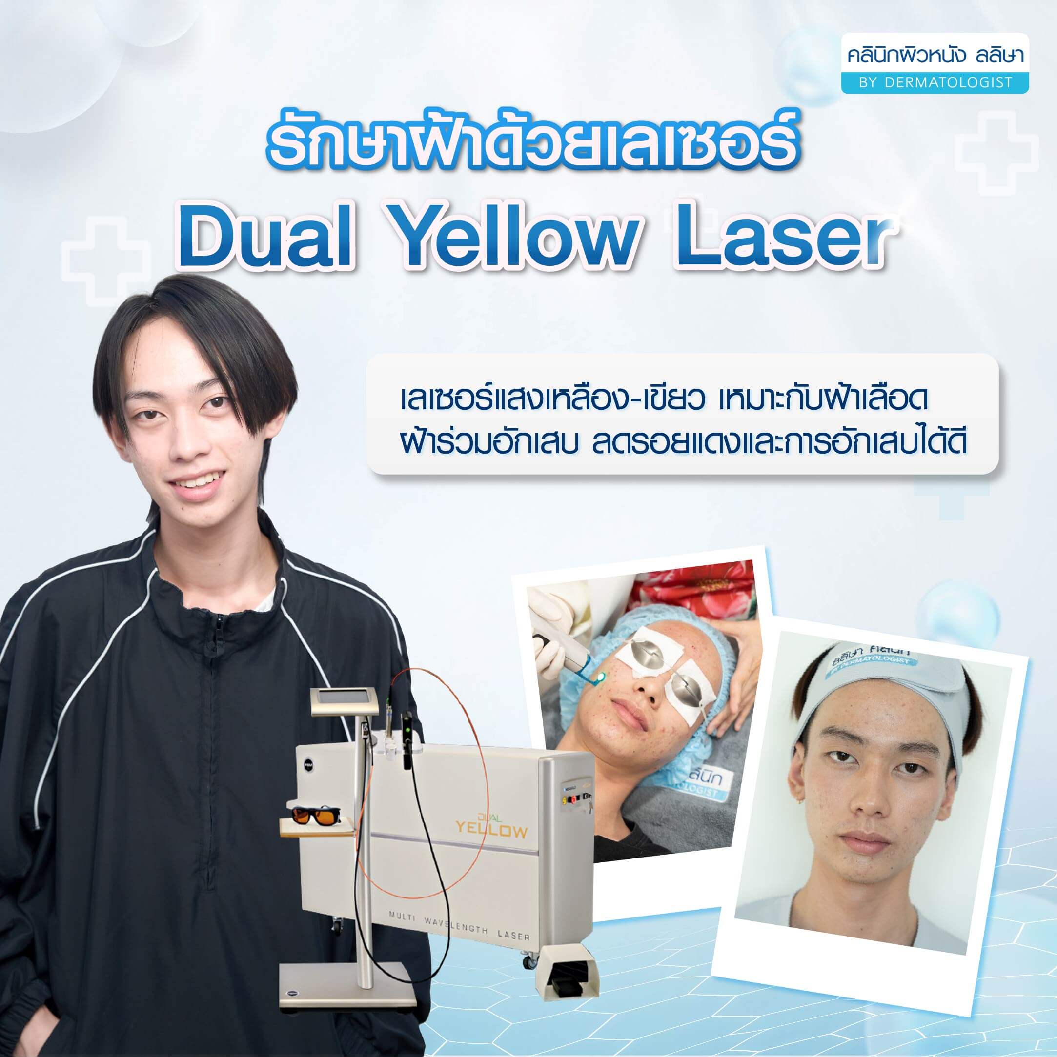 รักษาฝ้าด้วย Dual yellow laser