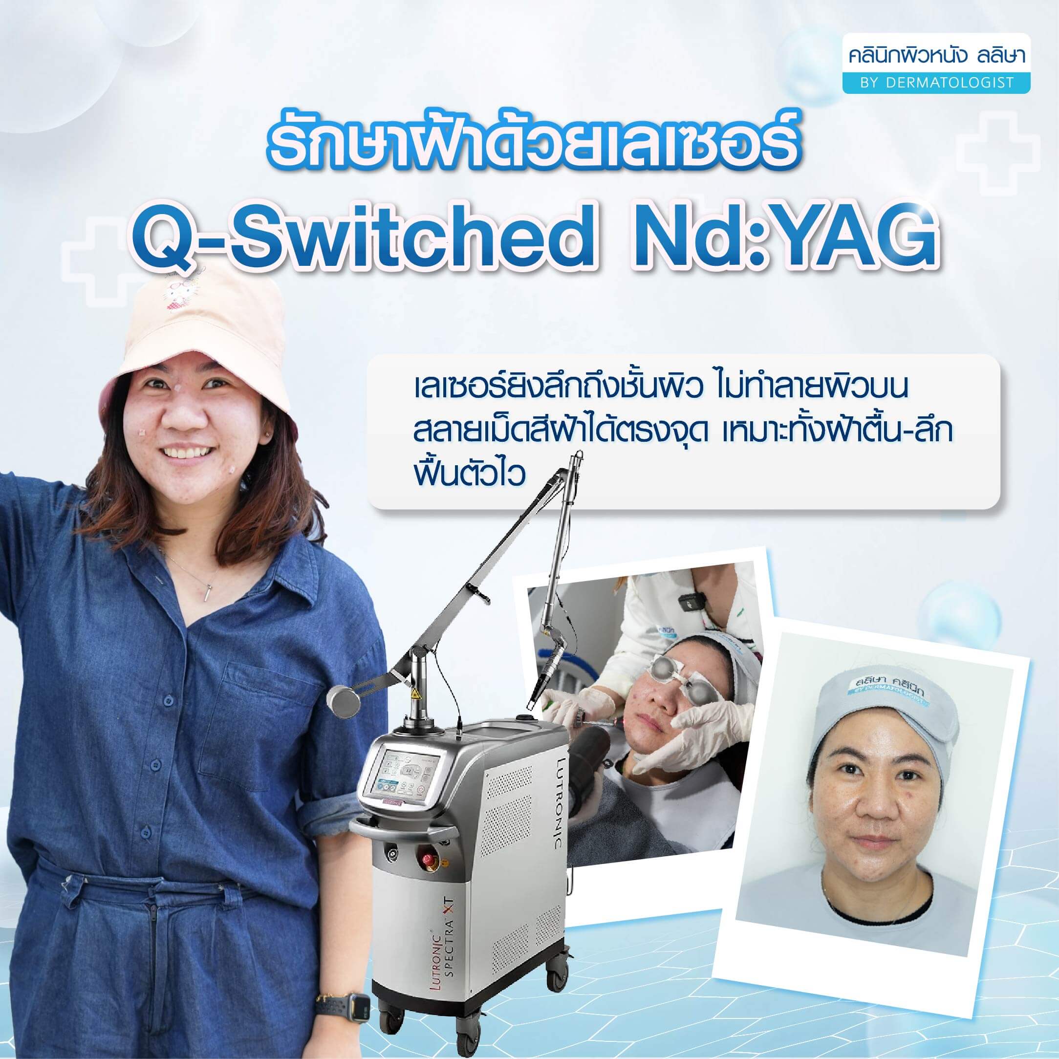 รักษาฝ้าด้วยเลเซอร์ Q switched