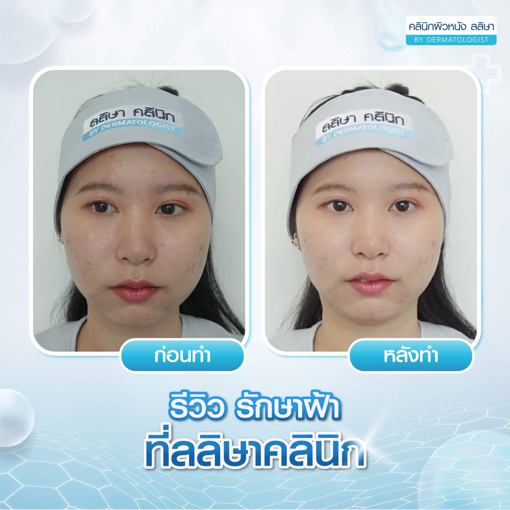 รีวิวรักษาฝ้าที่คลินิก