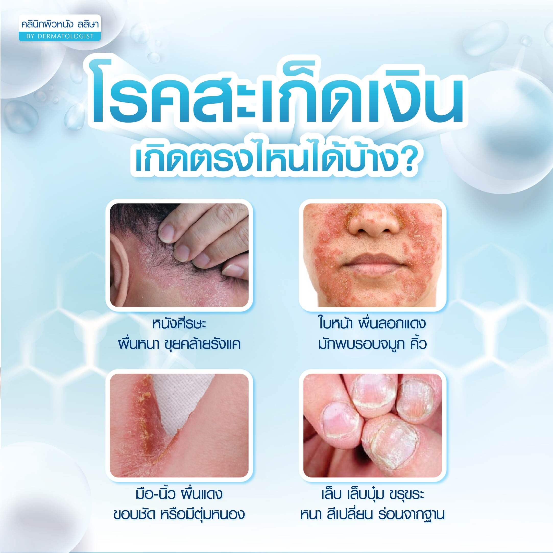 สะเก็ดเงิน ตำแหน่งที่พบบ่อย