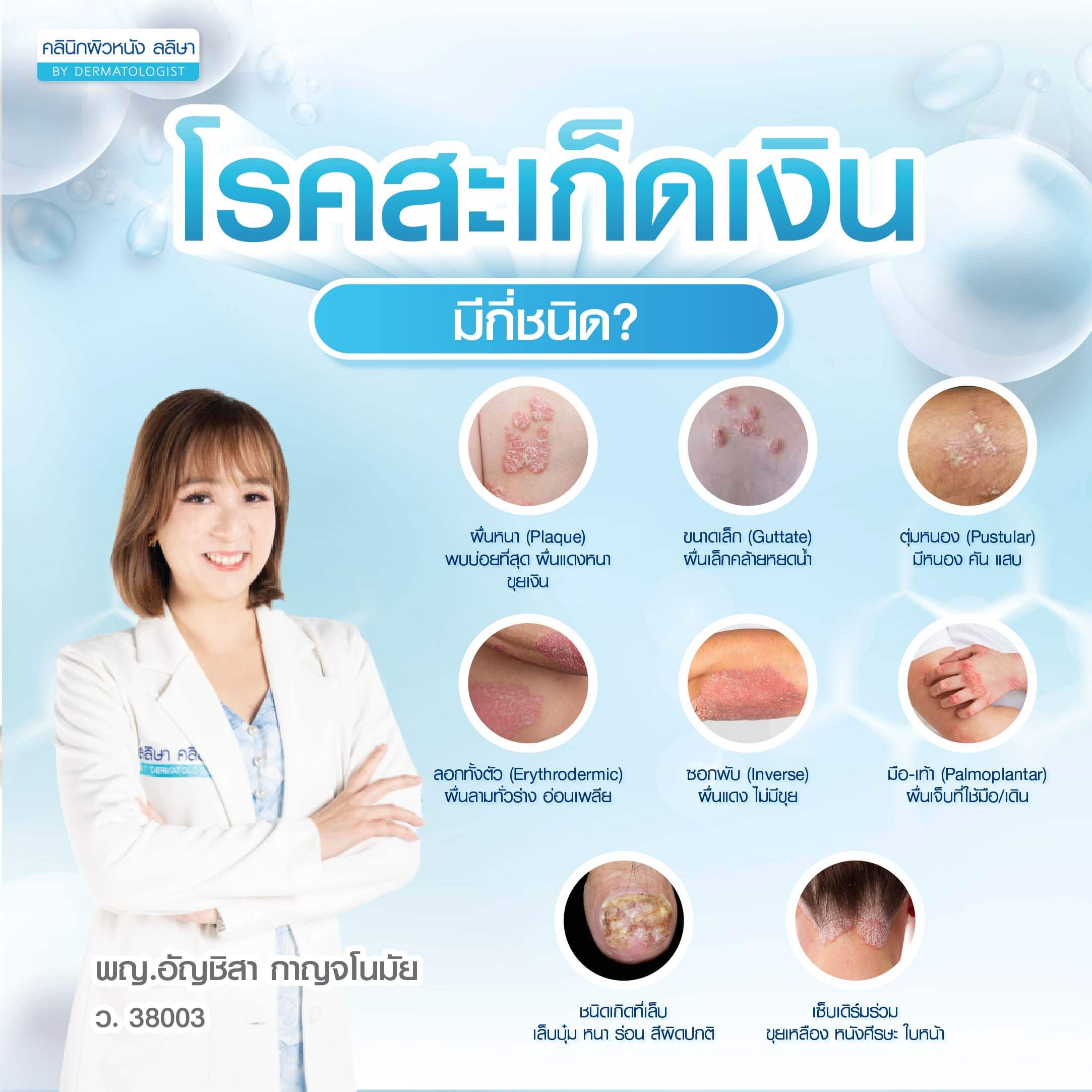 สะเก็ดเงิน มีกี่ชนิด