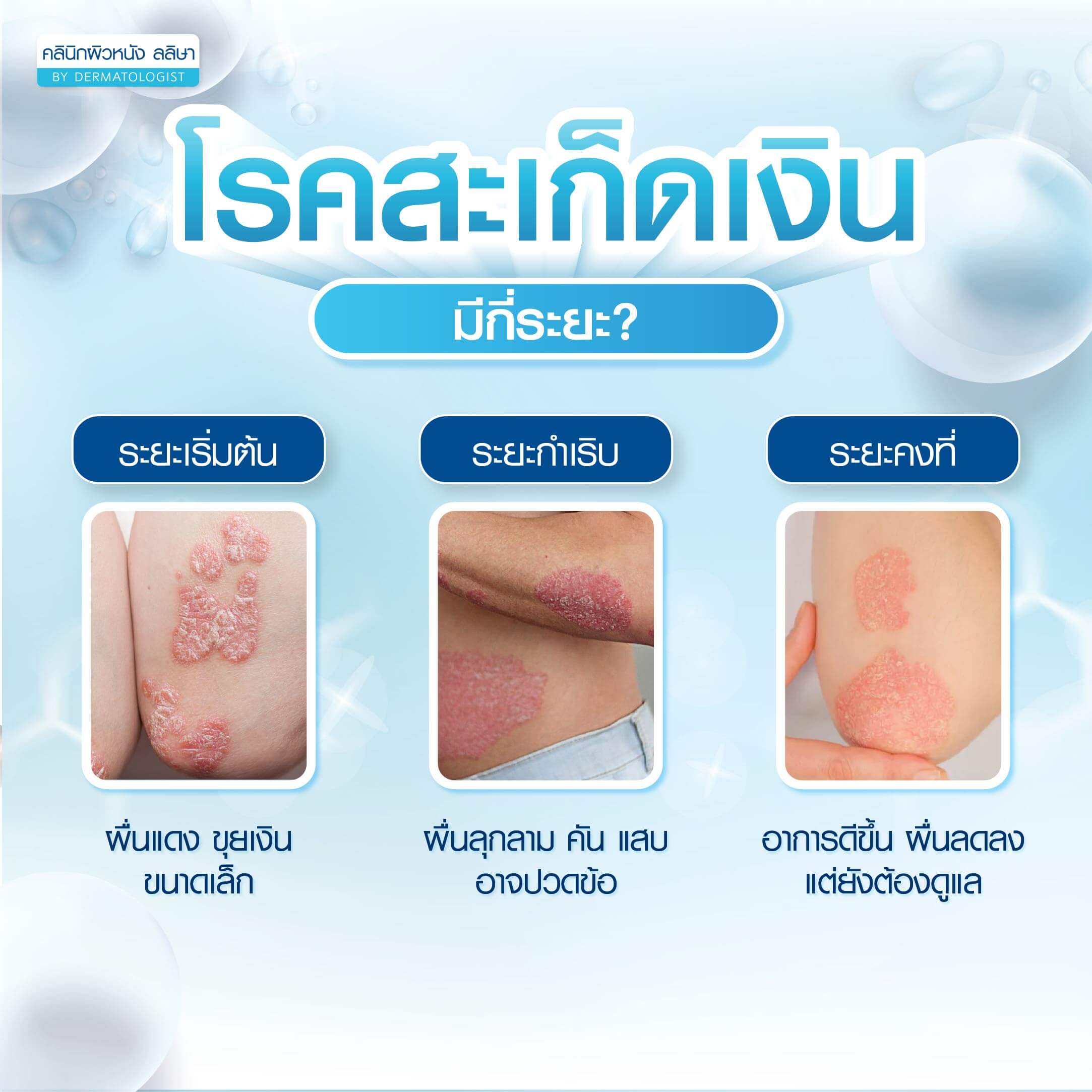 สะเก็ดเงิน มีกี่ระยะ