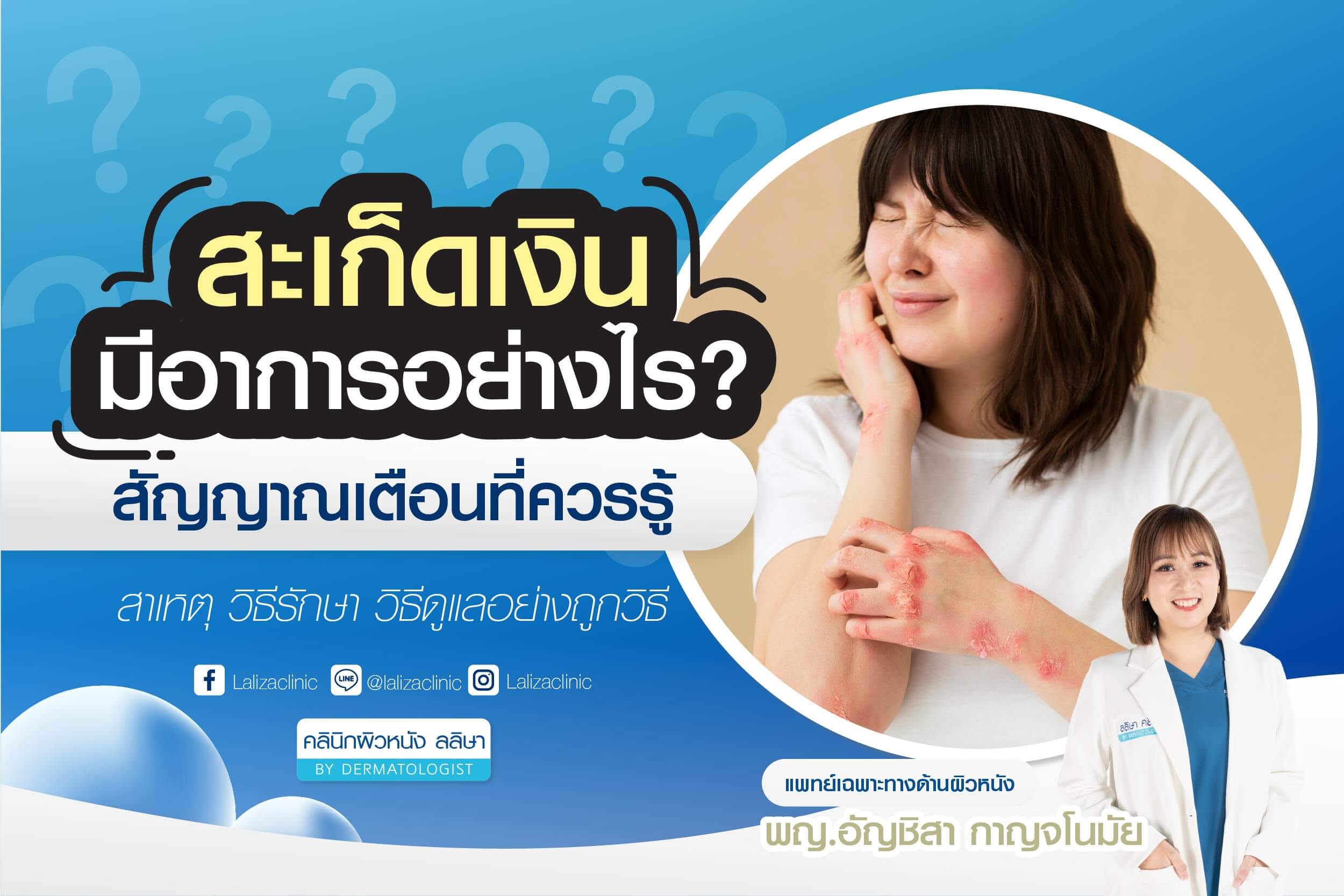 สะเก็ดเงิน รักษาอย่างไร