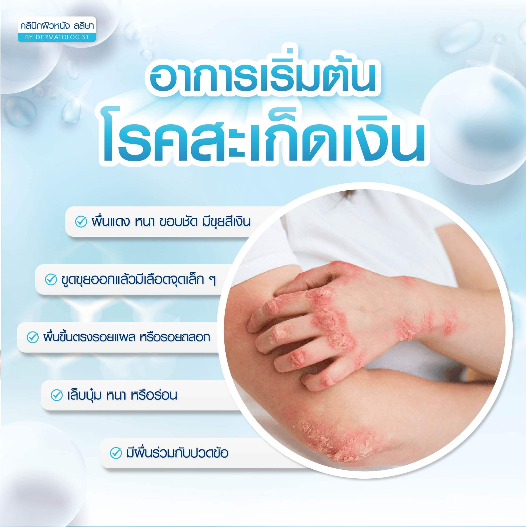 สะเก็ดเงิน อาการเริ่มต้นที่สังเกตได้